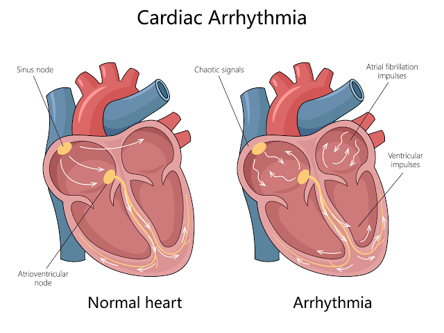 RECOGNIZING ARRHYTHMIAS BY THEIR ECG APPEARANCES RECOGNIZING ARRHYTHMIAS BY THEIR ECG APPEARANCES