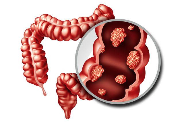 COMMON SIGNS OF COLON AND RECTAL TUMORS YOU SHOULD KNOW