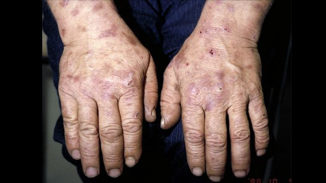 PORPHYRIA: ELUCIDATING A COMPLEX GROUP OF HEME BIOSYNTHESIS DISORDERS