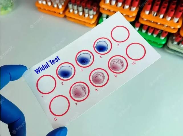 DIAGNOSTIC TEST FOR TYPHOID FEVER BY WIDAL TEST DIAGNOSTIC TEST FOR TYPHOID FEVER BY WIDAL TEST
