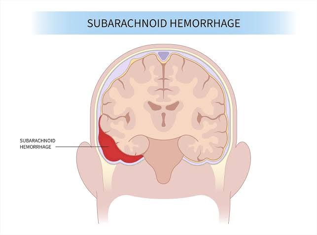 CEREBROVASCULAR ACCIDENTS: BRAIN HAEMORRHAGES EXPLAINED CEREBROVASCULAR ACCIDENTS: BRAIN HAEMORRHAGES EXPLAINED