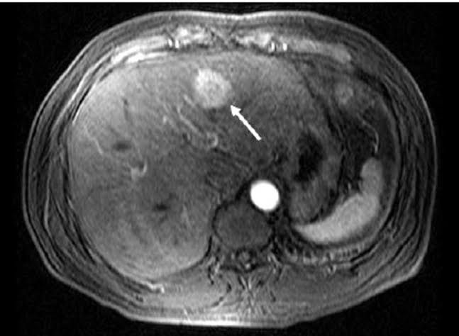 SPACE OCCUPYING LESIONS OF LIVER
