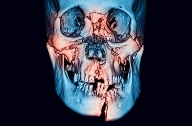 CSF RHINORRHEA AFTER FACIAL TRAUMA: DIAGNOSIS AND MANAGEMENT