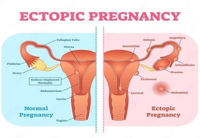 WORRIED ABOUT ECTOPIC PREGNANCY: LEARN THE FACTS NOW WORRIED ABOUT ECTOPIC PREGNANCY: LEARN THE FACTS NOW