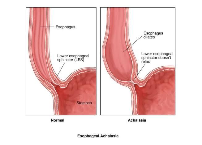 EFFECTIVE MANAGEMENT OF CARDIA ACHALASIA: ESSENTIAL DIAGNOSIS AND TREATMENT TIPS