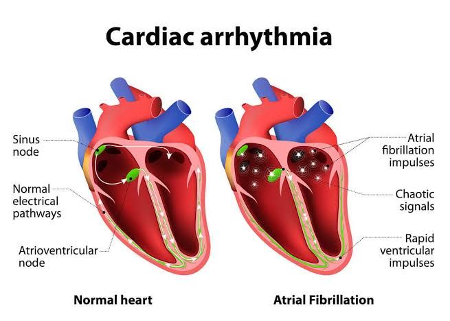 COMMON SIGNS YOU MIGHT HAVE AN ARRHYTHMIA