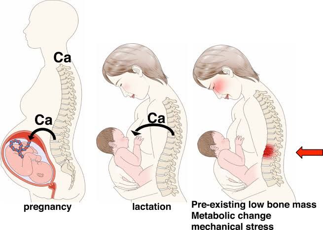BONE DENSITY IN LACTATION: UNDERSTANDING CHANGES, COMPLICATIONS, AND MANAGEMENT