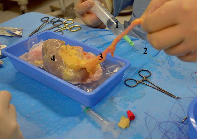 PREPARING THE KIDNEY FOR TRANSPLANT: KEY STEPS EXPLAINED