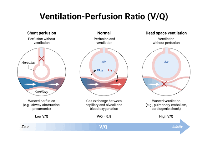 THE ESSENTIAL GUIDE TO UNDERSTANDING VENTILATION-PERFUSION RATIO THE ESSENTIAL GUIDE TO UNDERSTANDING VENTILATION-PERFUSION RATIO