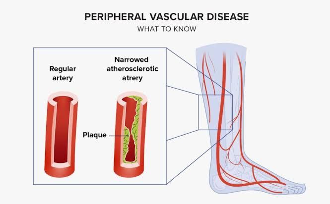 PERIPHERAL VASCULAR DISEASE: COMMON SIGNS AND RISKS PERIPHERAL VASCULAR DISEASE: COMMON SIGNS AND RISKS