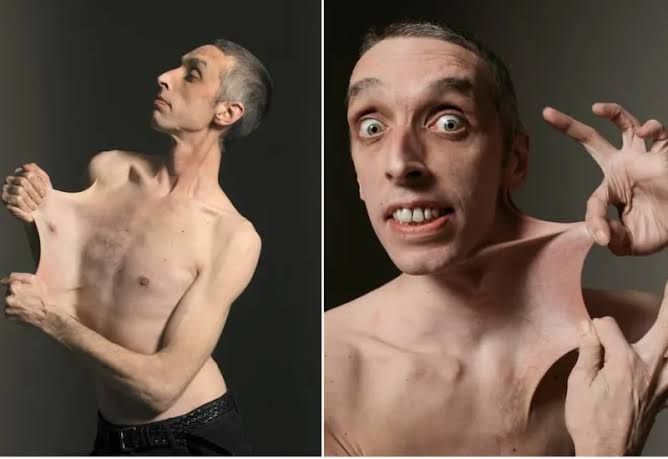 INHERITED COLLAGEN DISORDERS AND THEIR CLINICAL MANIFESTATIONS