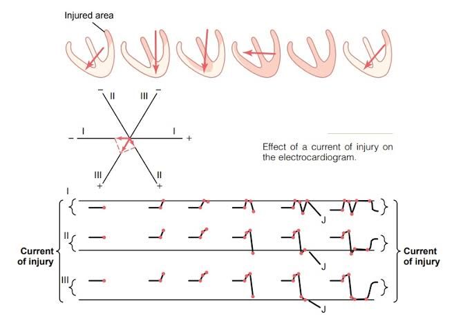 THE ROLE OF INJURY CURRENT IN MODIFYING THE ST SEGMENT