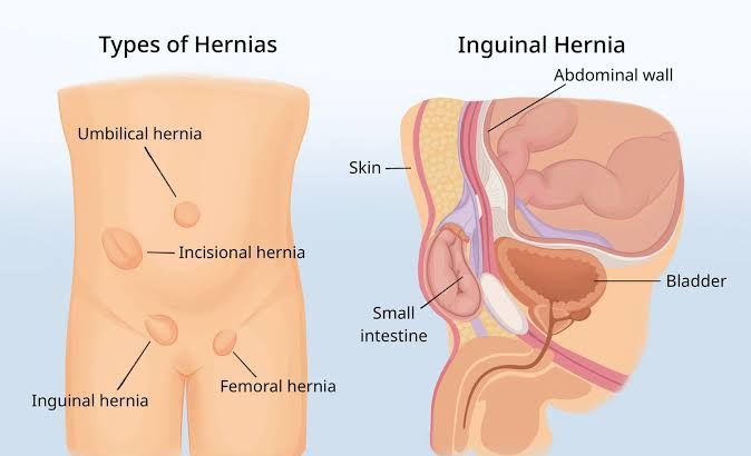 UNDERSTANDING ABDOMINAL WALL HERNIAS: KEY FACTS