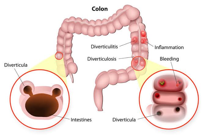 A CLOSER LOOK AT DIVERTICULOSIS AND MESENTERIC ISCHEMIA