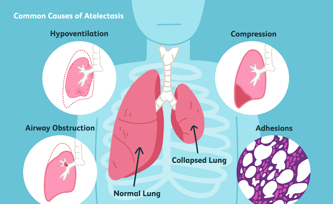 AN OVERVIEW OF ATELECTASIS AND DISTURBANCES OF PULMONARY CIRCULATION