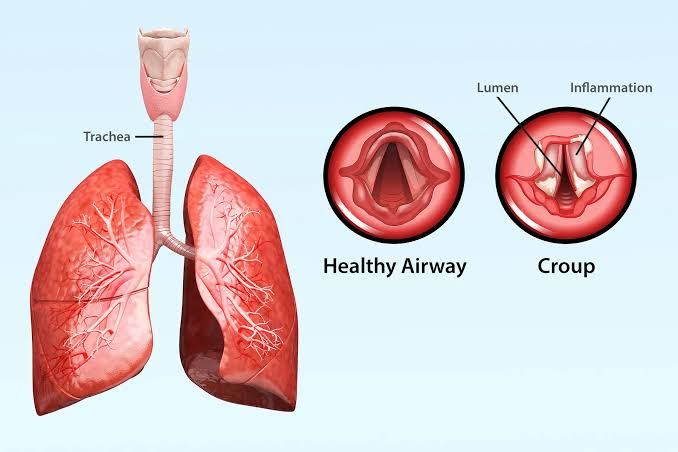 EFFECTIVE MANAGEMENT OF CROUP: A COMPLETE APPROACH FOR CLINICIANS