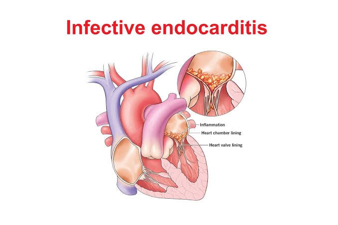 INFECTIVE ENDOCARDITIS: WHAT YOU SHOULD KNOW INFECTIVE ENDOCARDITIS: WHAT YOU SHOULD KNOW