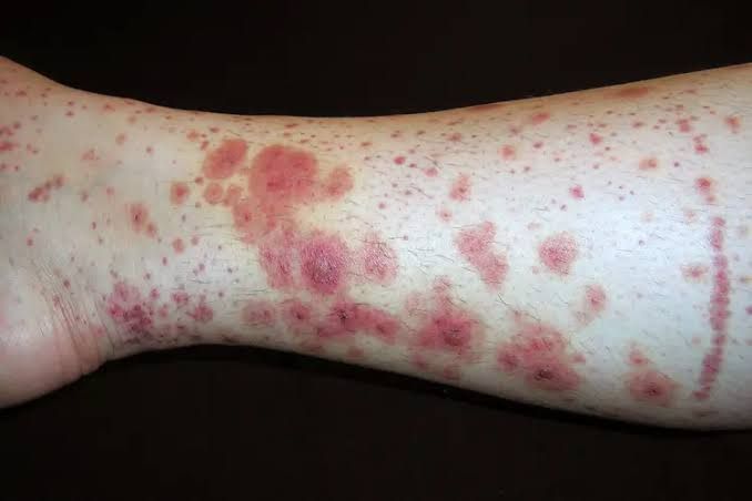HOW DOCTORS DIAGNOSE PURPURA AND WHAT TO EXPECT | MY SCHOOL EXAMS