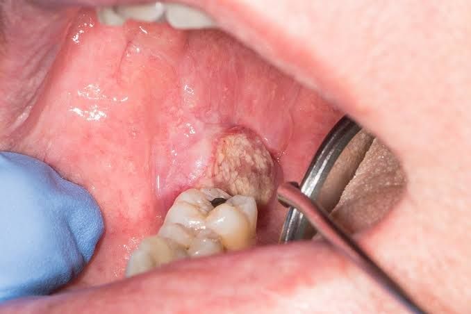 EARLY WARNING SIGNS OF MOUTH CANCER YOU SHOULD KNOW