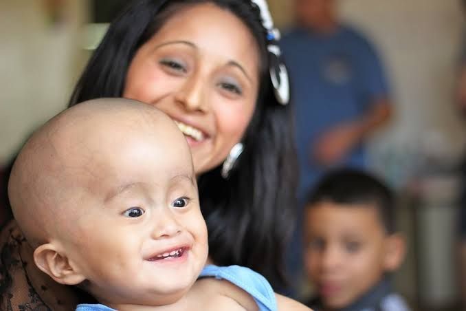 HYDROCEPHALUS AND SPINAL DYSRAPHISM DIAGNOSIS AND MANAGEMENT HYDROCEPHALUS AND SPINAL DYSRAPHISM DIAGNOSIS AND MANAGEMENT