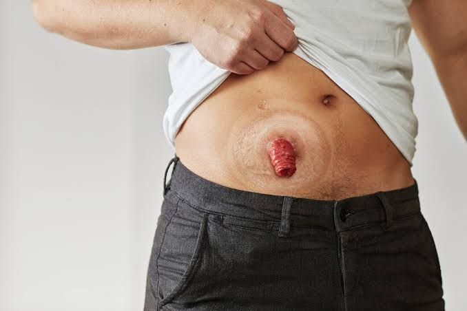 WHAT TO WATCH FOR AFTER GETTING A STOMA