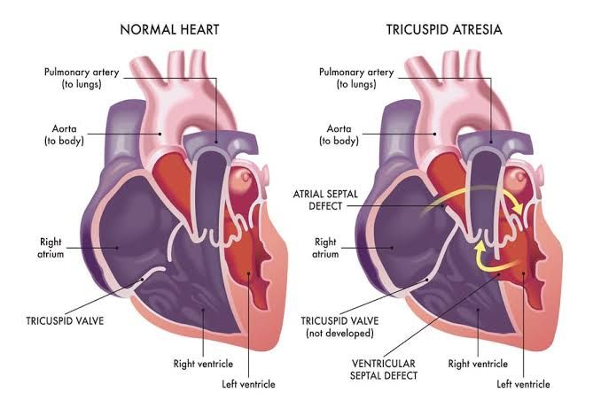 TRICUSPID ATRESIA IN CHILDREN: CAUSES, RISK FACTORS, AND MANAGEMENT