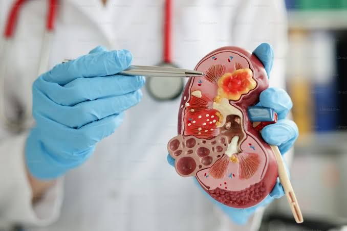 CHRONIC RENAL FAILURE EXPLAINED: YOUR COMPLETE OVERVIEW CHRONIC RENAL FAILURE EXPLAINED: YOUR COMPLETE OVERVIEW