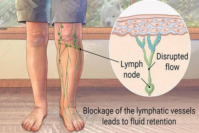 PATIENT STORIES: LIVING WITH LYMPHEDEMA AND OVERCOMING CHALLENGES PATIENT STORIES: LIVING WITH LYMPHEDEMA AND OVERCOMING CHALLENGES
