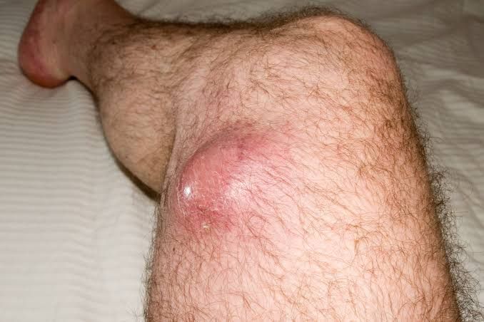 SOFT TISSUE TUMORS: TYPES AND HOW THEY ARE DIAGNOSED SOFT TISSUE TUMORS: TYPES AND HOW THEY ARE DIAGNOSED
