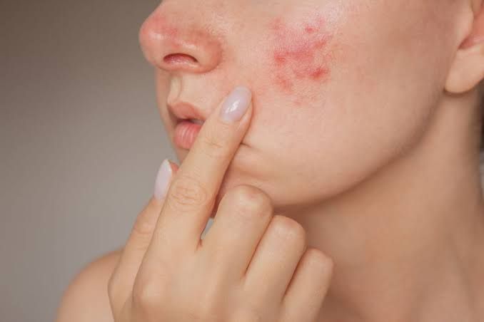 APPROACH TO PATIENT WITH COMMON FACIAL RASHES: ACNE AND ROSACEA APPROACH TO PATIENT WITH COMMON FACIAL RASHES: ACNE AND ROSACEA