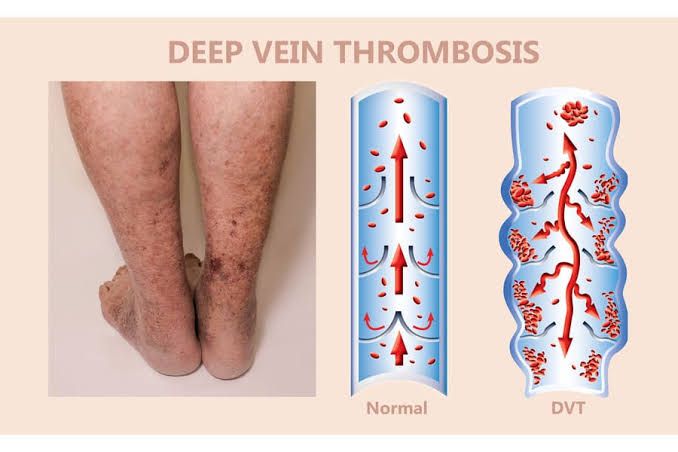 A COMPREHENSIVE INTRODUCTION TO THROMBOEMBOLISM FOR MEDICAL STUDENTS
