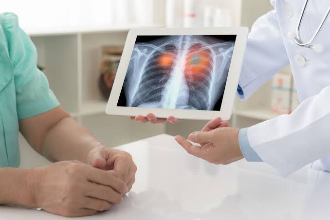 PRIMARY AND SECONDARY LUNG NEOPLASMS PRIMARY AND SECONDARY LUNG NEOPLASMS