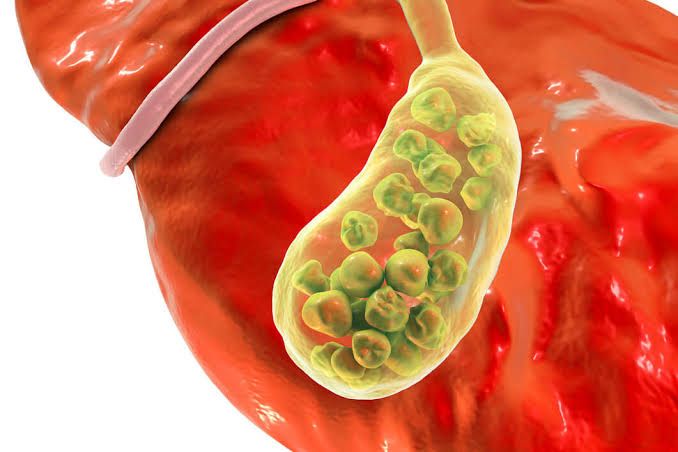 COMPLICATIONS OF GALLSTONES AND JAUNDICE COMPLICATIONS OF GALLSTONES AND JAUNDICE