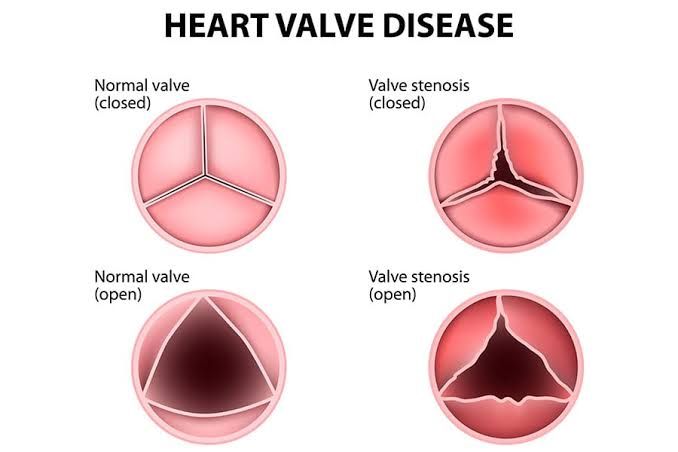 TOP STRATEGIES FOR MANAGING VALVULAR HEART DISEASES EFFECTIVELY