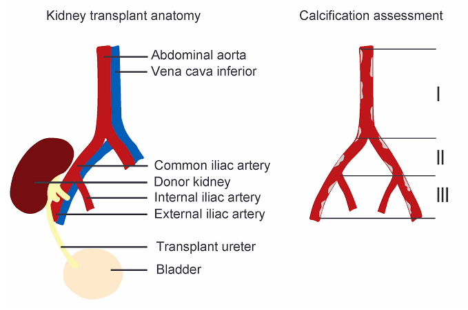 SURGICAL TECHNIQUE: ISOLATION OF ILIAC VESSELS AND VASCULAR ANASTOMOSIS