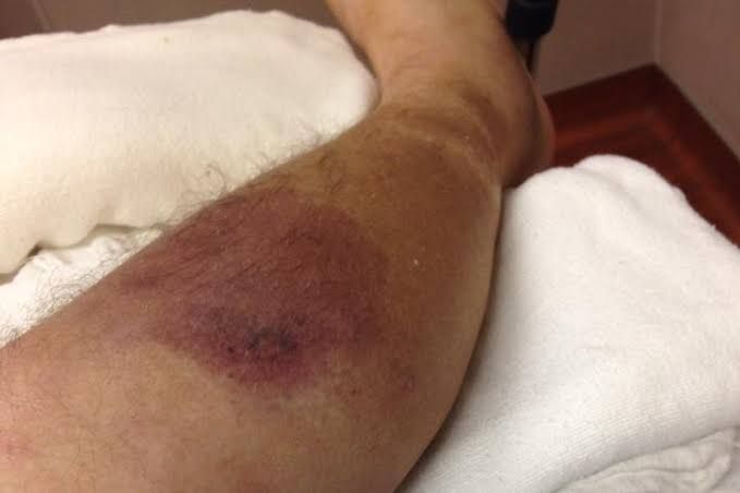 TREATING NECROTIZING SOFT TISSUE INFECTIONS EFFECTIVELY