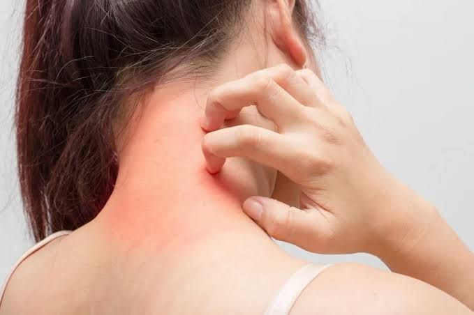 AN OVERVIEW OF ALLERGY AND HYPERSENSITIVITY AN OVERVIEW OF ALLERGY AND HYPERSENSITIVITY