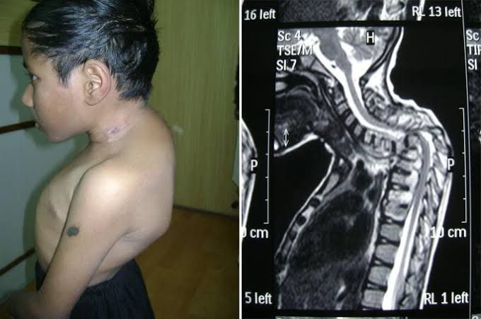EXPLORING THE CAUSES AND DIAGNOSIS OF POTT’S DISEASE IN MODERN MEDICINE