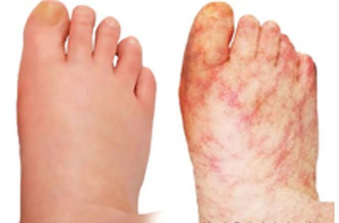 ANTIPHOSPHOLIPID SYNDROME: CLINICAL FEATURES, INVESTIGATIONS, MANAGEMENT, PROGNOSIS, AND COMPLICATIONS