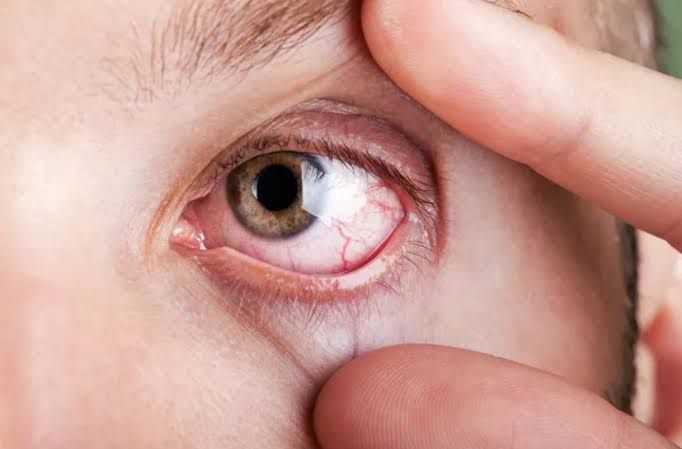 EFFECTIVE STRATEGIES FOR MANAGING XEROPHTHALMIA AND IMPROVING EYE HEALTH