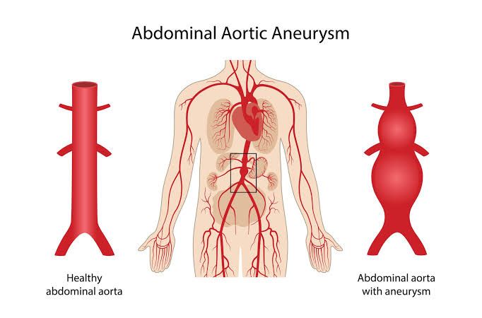 TREATMENT OPTIONS FOR ANEURYSMS AND VASCULAR ISSUES