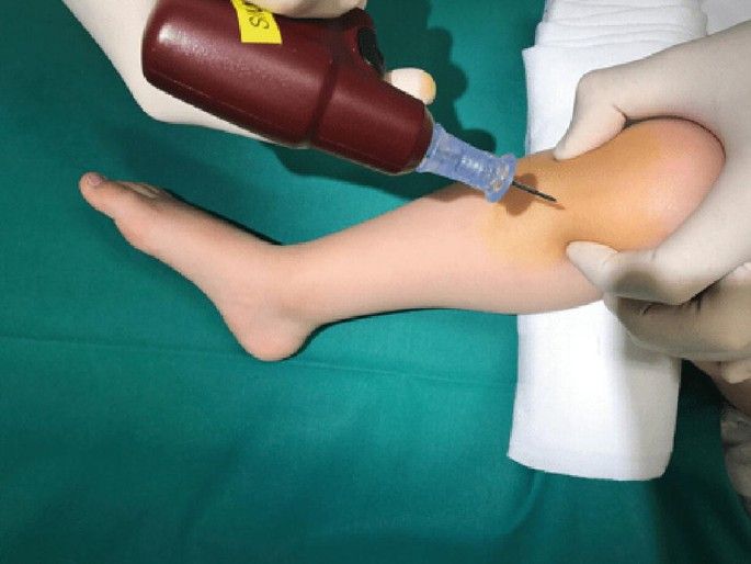MASTERING THE MANUAL INSERTION TECHNIQUE FOR INTRAOSSEOUS INFUSION LINES