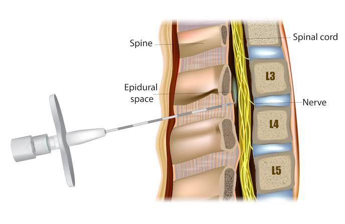 EXPLORING THE SINGLE-SHOT SPINAL TECHNIQUE FOR SAFE CAESAREAN DELIVERIES