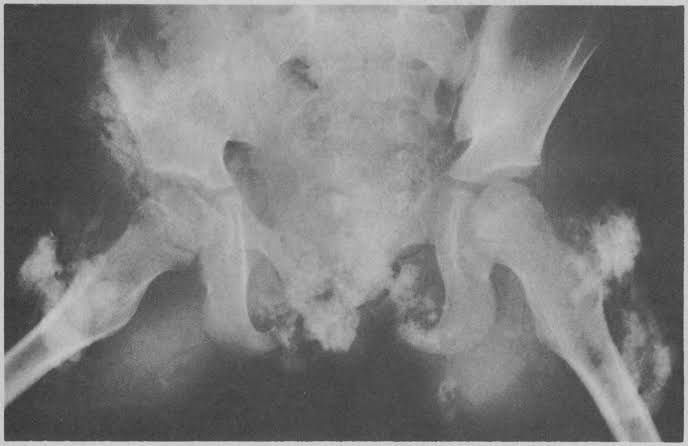 NAVIGATING PATHOLOGICAL CALCIFICATION: A GUIDE