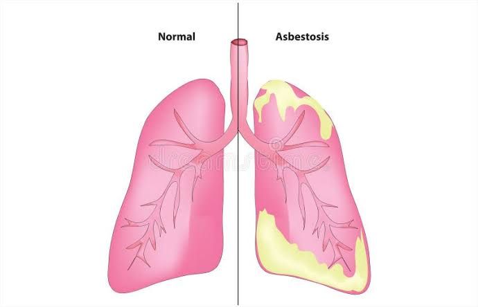 LIVING WITH RESTRICTIVE LUNG DISEASE: PATIENT SUPPORT TIPS