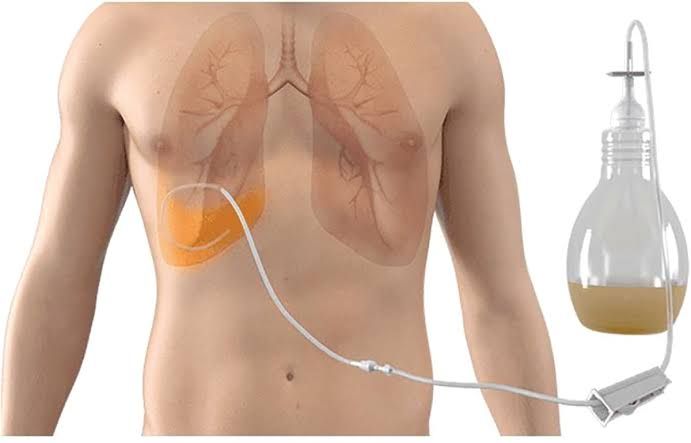 WHAT YOU NEED TO KNOW ABOUT MEDICAL TUBES AND DRAINS