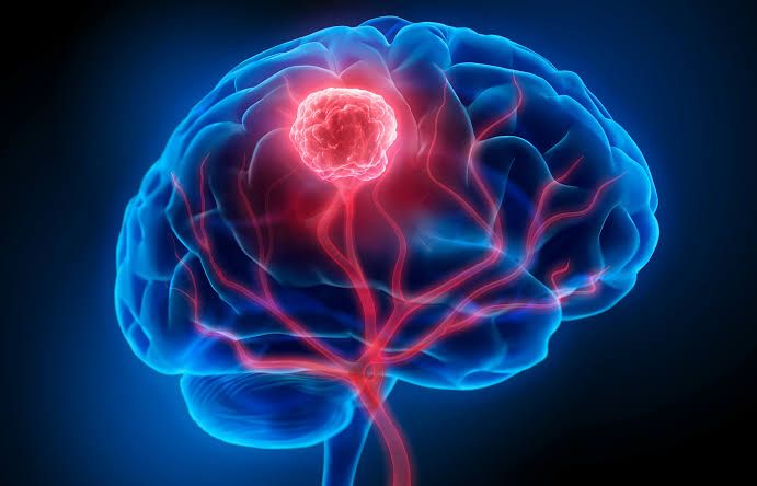 QUICK GUIDE TO CNS TUMOR DIAGNOSIS AND CARE QUICK GUIDE TO CNS TUMOR DIAGNOSIS AND CARE