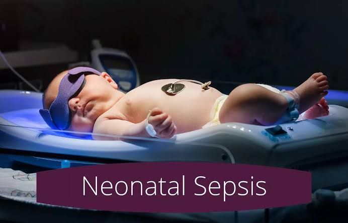 UNDERSTANDING NEONATAL SEPSIS: SYMPTOMS, CAUSES, AND TREATMENT