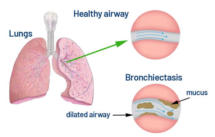 BRONCHIECTASIS: WHAT YOU NEED TO KNOW ABOUT IT BRONCHIECTASIS: WHAT YOU NEED TO KNOW ABOUT IT