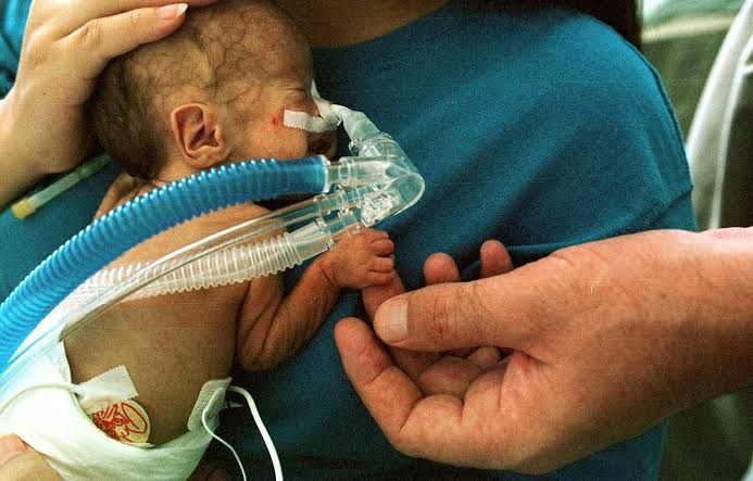 HOW TO MANAGE RESPIRATORY DISTRESS IN NEWBORNS